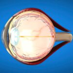 What is Acute Glaucoma?