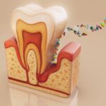 Actinomycosis: Understanding a Rare but Serious Infection
