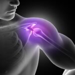 Understanding Shoulder Dislocation: Causes, Symptoms, and Treatment